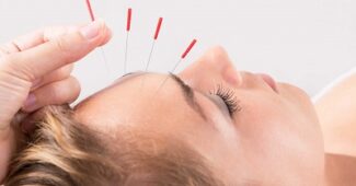 lifting visage par acupuncture