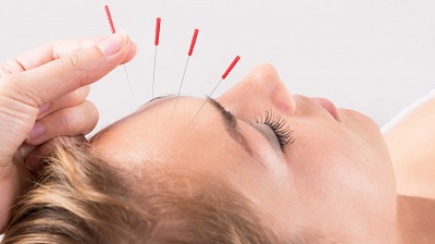 lifting visage par acupuncture