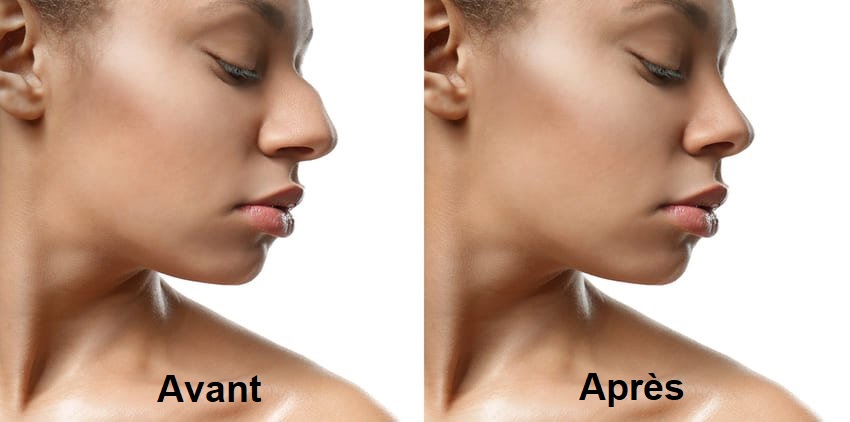 Photos avant et après rhinoplastie ethnique