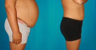 abdominoplastie paris