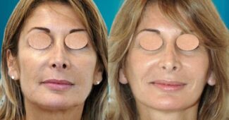 lifting fronto-facial Paris