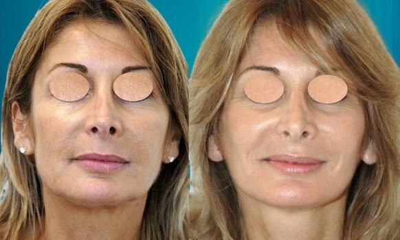 lifting fronto-facial Paris