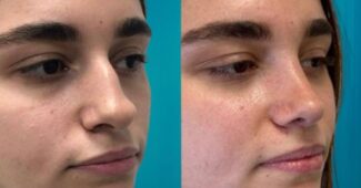 rhinoplastie ultrasonique